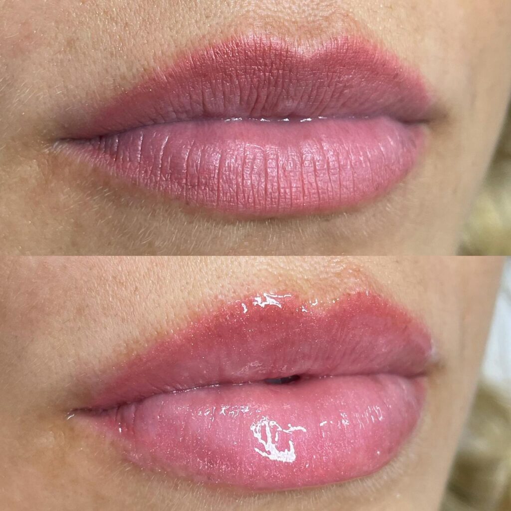 A técnica hydra lips gloss promove hidratação e rejuvenscimento dos lábios.